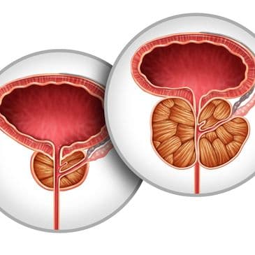 Prostate Cancer